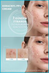 Yağlı Ve Akneye Eğilimli Ciltler Için Bakım Kremi 30ml